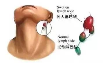 淋巴瘤日本,日本视角下的疾病认知与治疗进展
